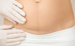 Número de cesarianas cai na saúde suplementar