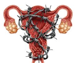 Endometriose pode ser diagnosticada na adolescência, o que garante mais qualidade de vida às mulheres
